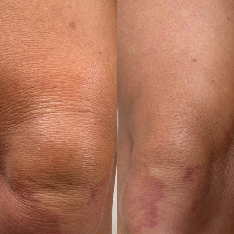 A before and after image of a knee from undergoing Profhilo & Profhilo Body treatment. Seeing the clear signs of smoother skin that looks younger