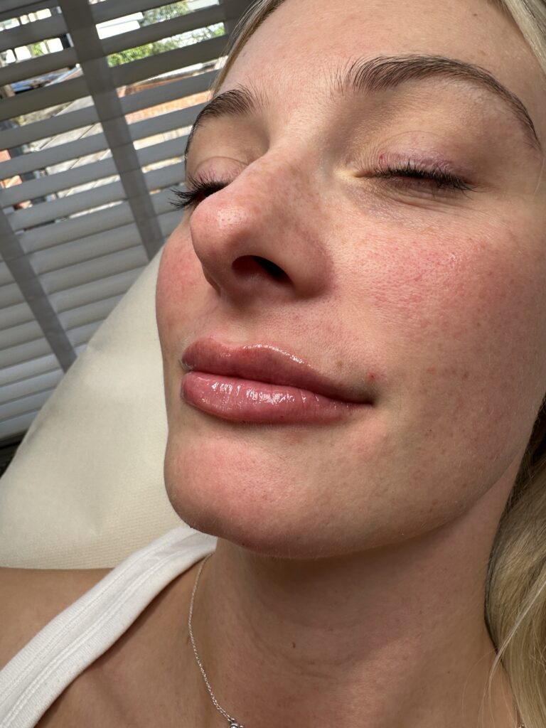 A stunning transformational image showing the benefits of undergoing a lip filler treatment