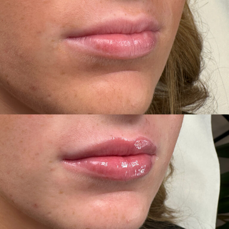 A successful lip filler before and after image showcasing the transformation that Lip Filler treatments can have with BU Aesthetics