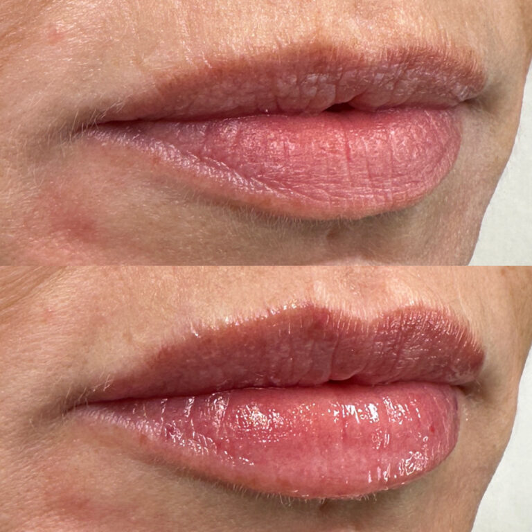 A stunning before and after image of a successful lip filler treatment through Caroline and BU Aesthetics