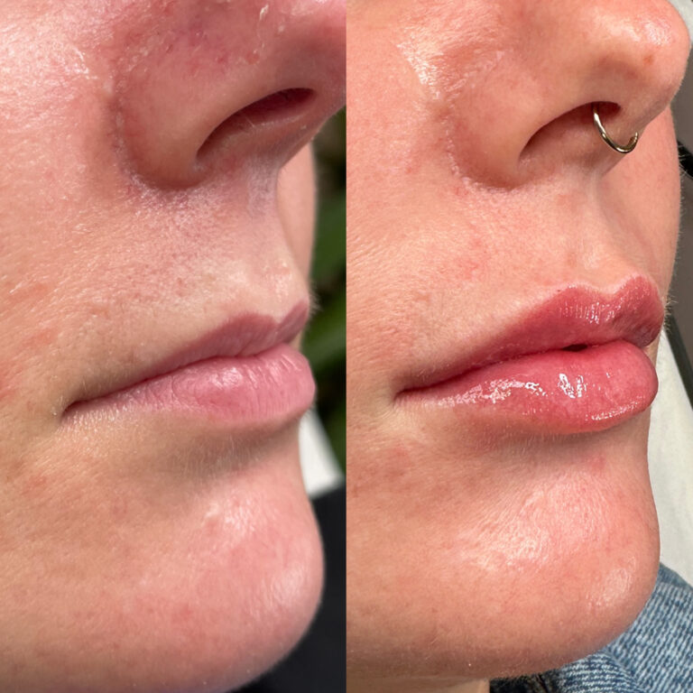 A before and after image showing a successful transformation of a lip filler treatment with Caroline from BU Aesthetics