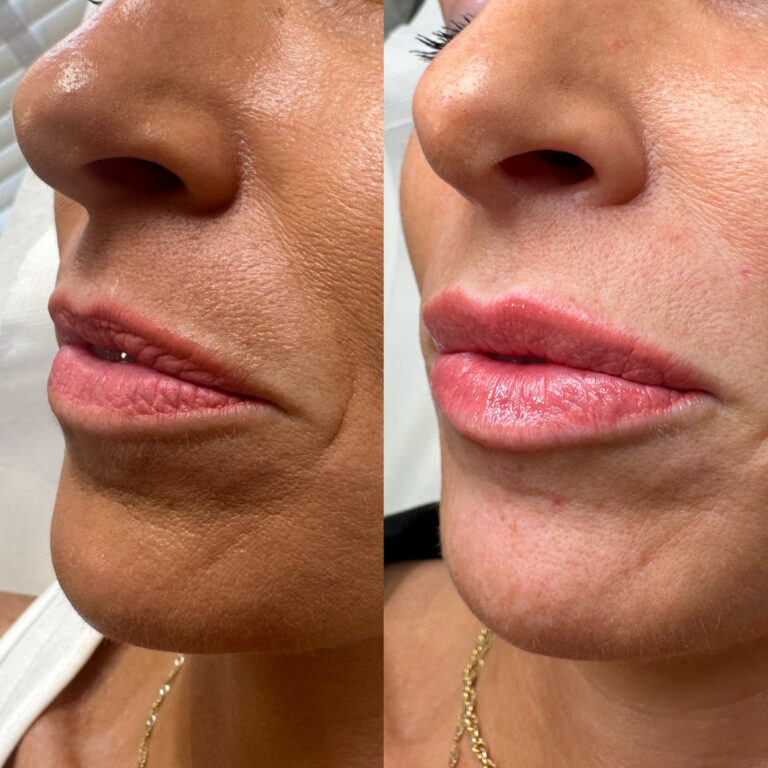 A before and after image of a woman undergoing a successful lip filler treatment with BU Aesthetics and Caroline