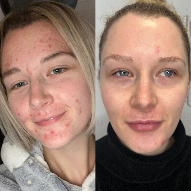 A before and after picture of a woman undergoing the Obagi Medical Grade Skincare treatment
