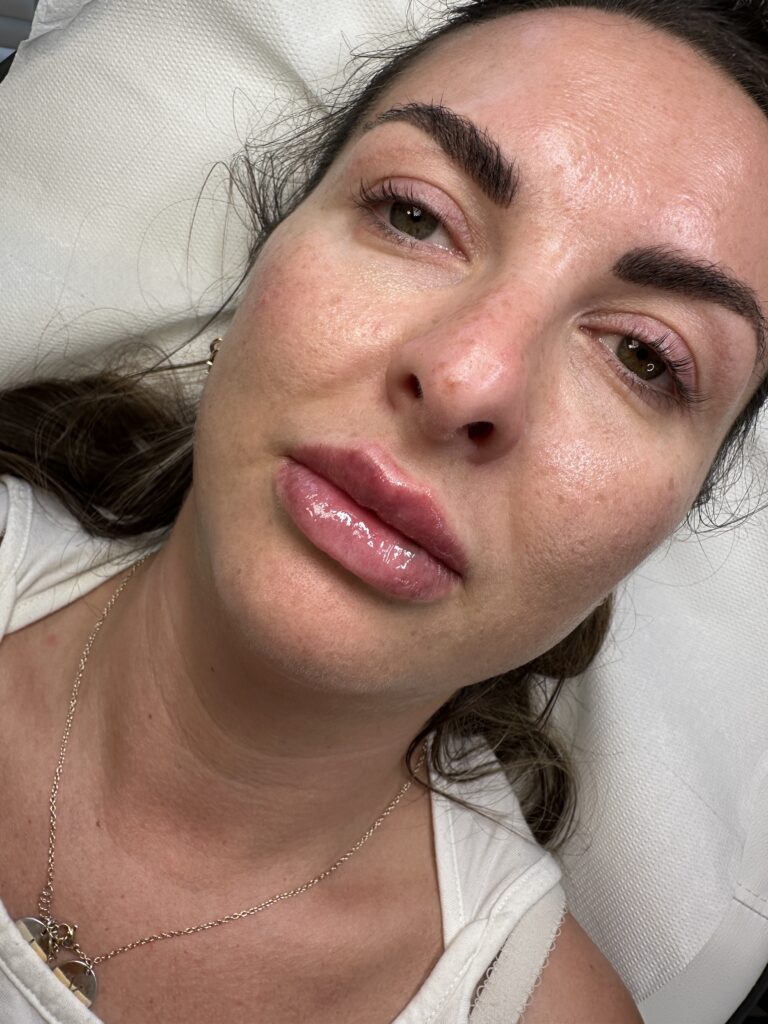 A photo showing a woman having undergone a successful lip filler treatment with BU Aesthetics