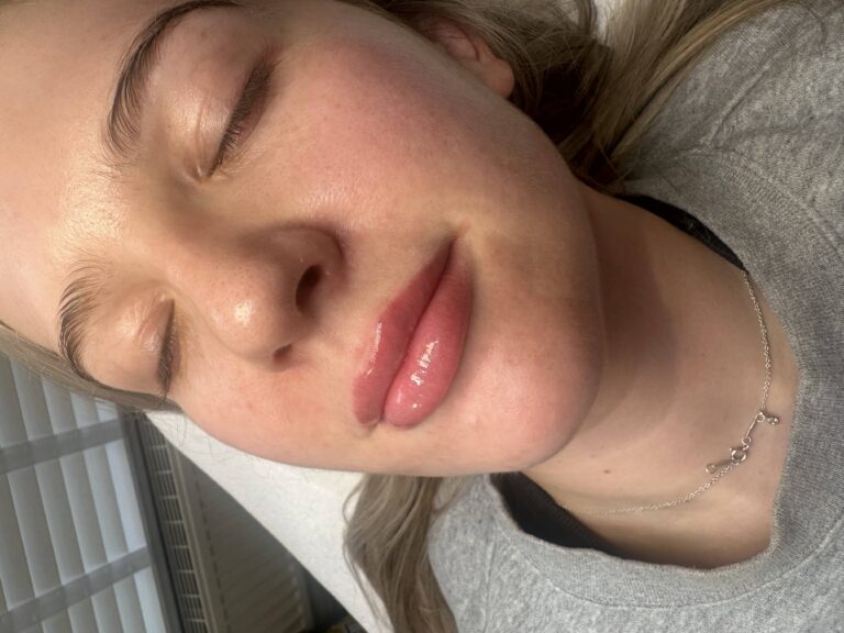 A transformative image showcasing the difference after a woman has undergone a successful lip filler treatment with BU Aesthetics with Caroline