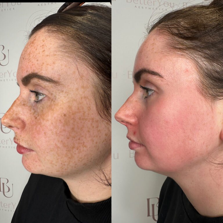 A before and after image of a woman who has undergone the Obagi Medical Grade Skincare treatment to remove freckles from her face.