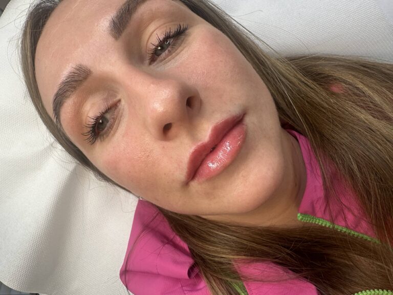 A transformative photo, showing a woman having undergone a lip fillers treatment with BU Aesthetics