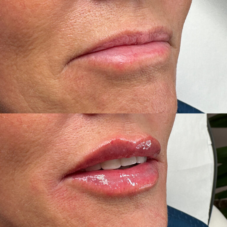 A before and after image of a woman undergoing the lip fillers treatment with Caroline from BU Aesthetics