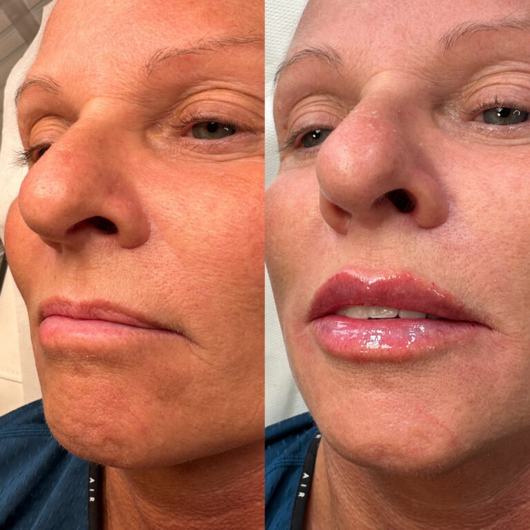 A photo of a before and after image of a woman undergoing the lip filler treatment with BU Aesthetics.