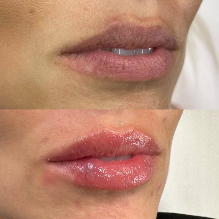 A before and after image of a woman undergoing a lip filler treatment with BU Aesthetics.