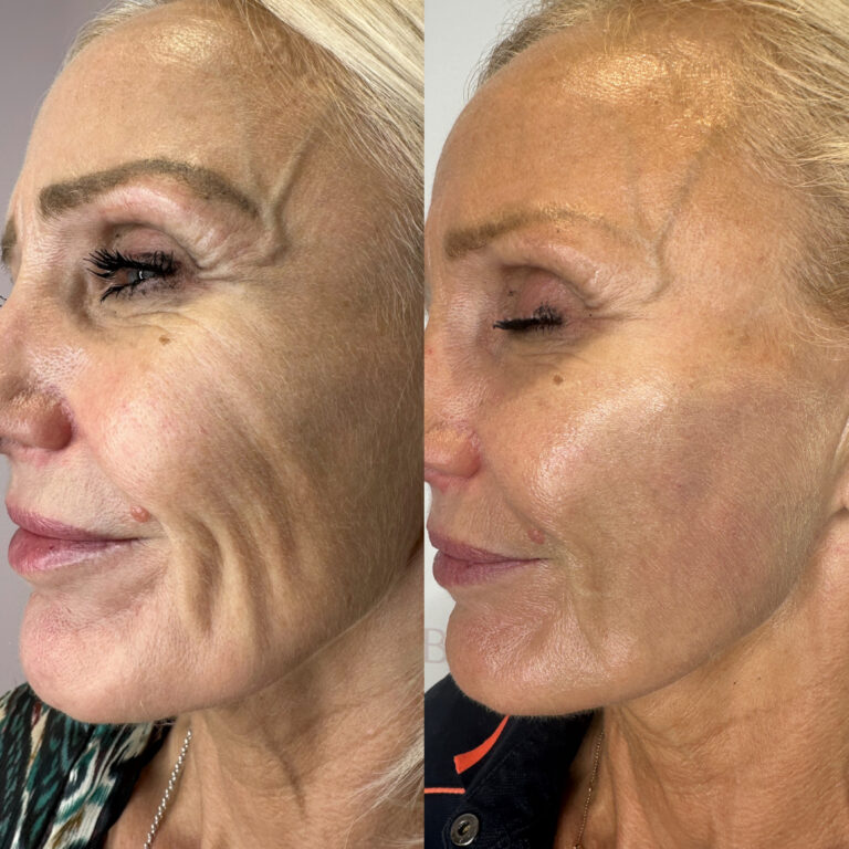 A before and after image showing the effects of a patient undergoing the HArmonyCa process