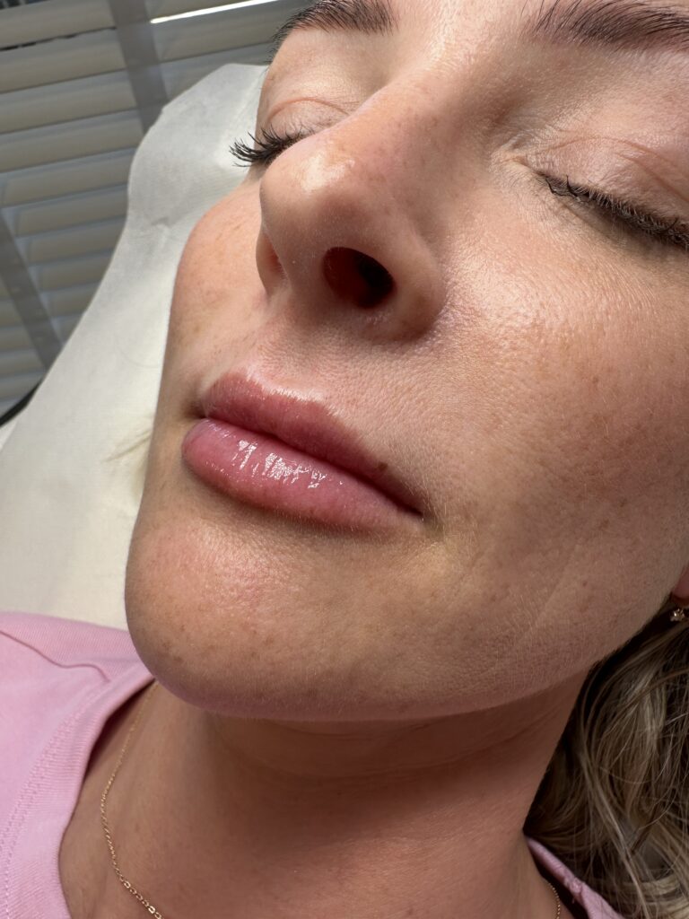 A close up image of a woman having undergone a lip filler treatment with BU Aesthetics