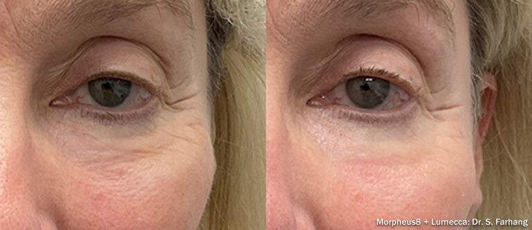 Morpheus 8 Burst Before and After