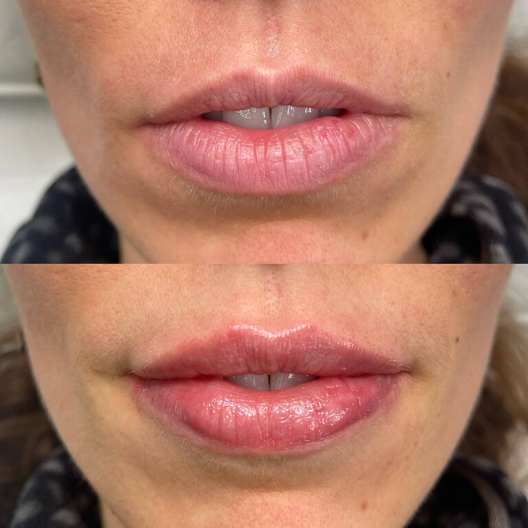 A stunning transformational image of a lip filler treatment with BU Aesthetics and Caroline