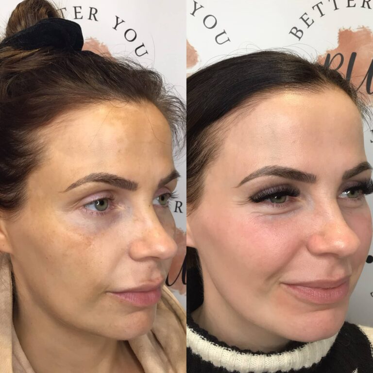 A stunning before and after comparison image of the impact that Obagi Medical Grade Skincare treatment with BU Aesthetics