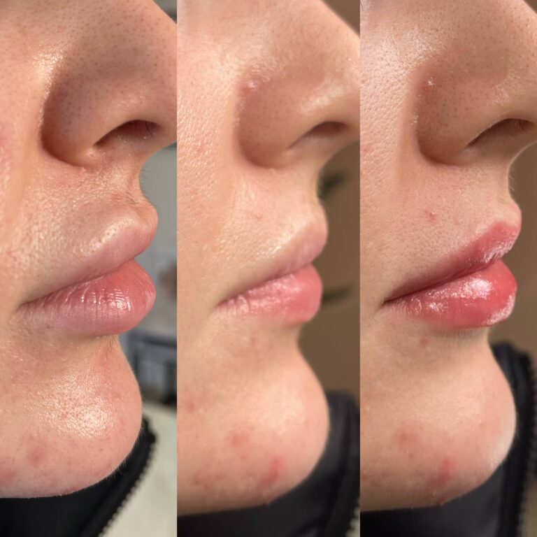 An amazing transformational image showcasing the before and after effects of lip fillers from BU Aesthetics performed by Caroline