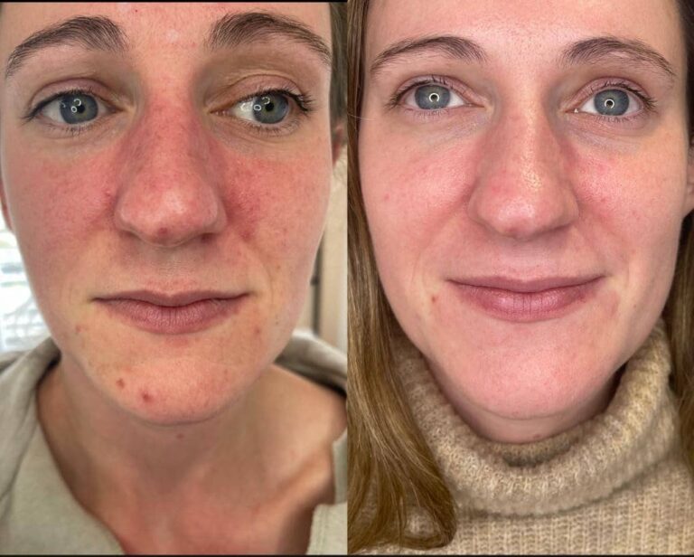 A stunning before and after image of the Obagi Medical Grade Skincare treatment through Caroline and BU Aesthetics on the Wirral