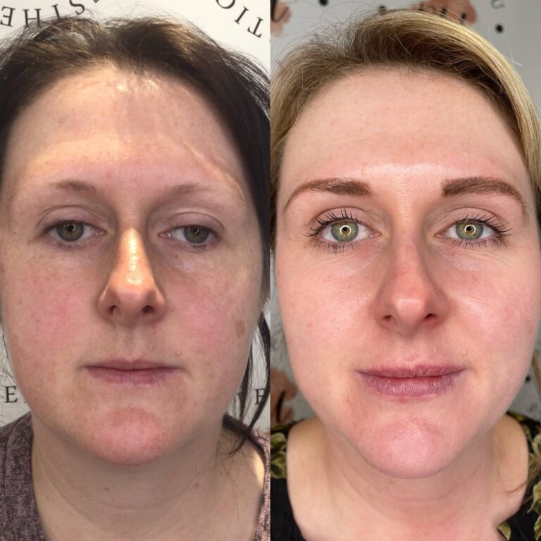 A stunning before and after image showing the incredible transformation of using Obagi Medical Grade Skincare with BU Aesthetics