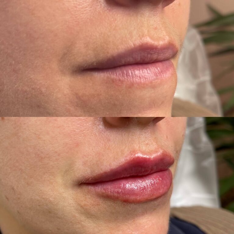 A stunning before and after image showing the amazing transformation of what lip fillers can provide