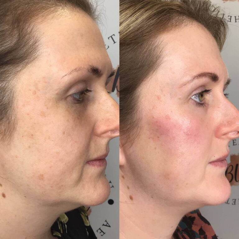 A stunning transformation of a before and after image of the Obagi Medical Grade Skincare from BU Aesthetics with Caroline.