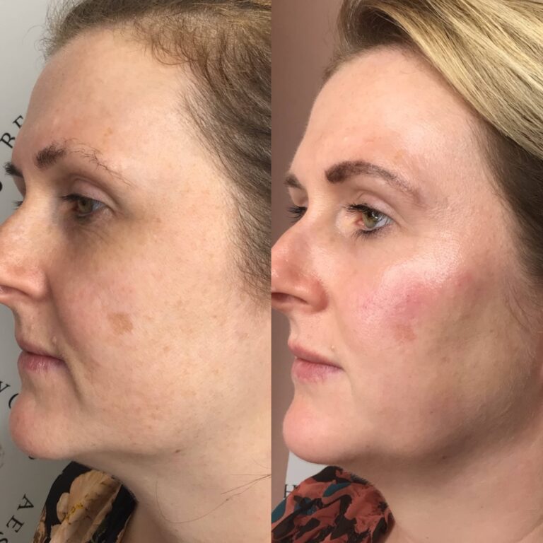 A stunning before and after image of the Obagi Medical Grade Skincare treatment through Caroline and BU Aesthetics