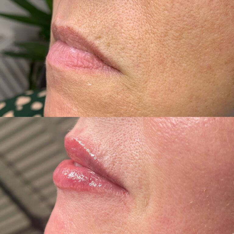 A stunning transformational image of a lip filler treatment with BU Aesthetics by Caroline