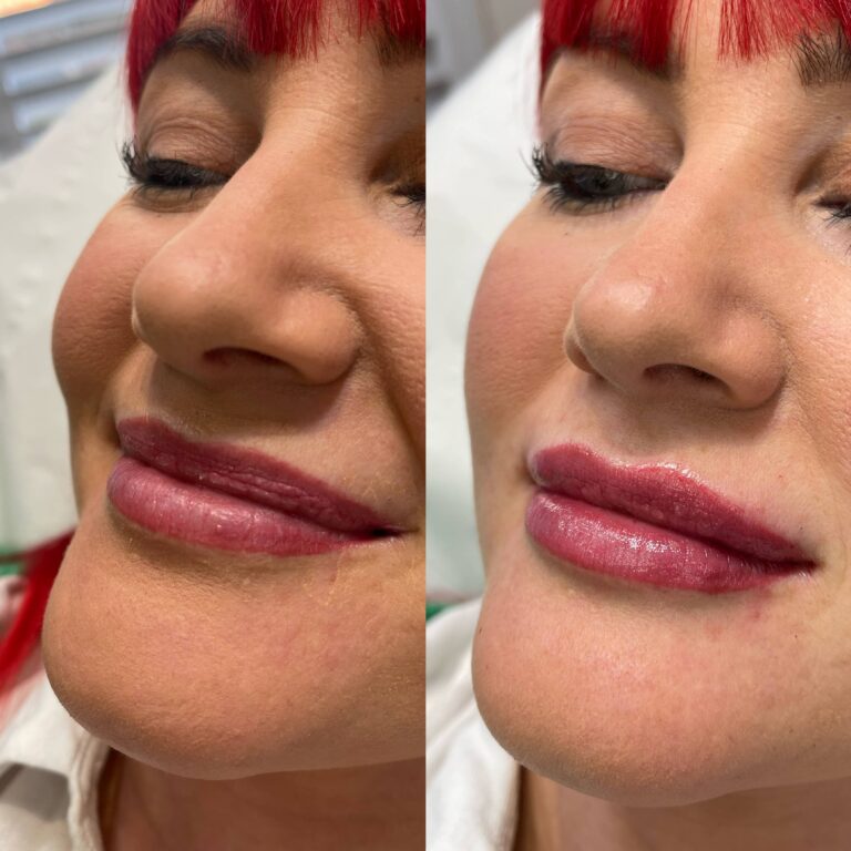 A stunning transformation showcasing the amazing transformation of lip filler treatment with BU Aesthetics