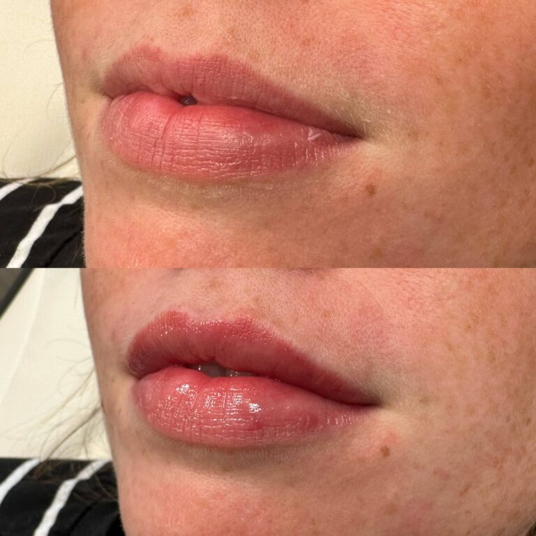 A stunning before and after image showcasing the benefits of lip fillers
