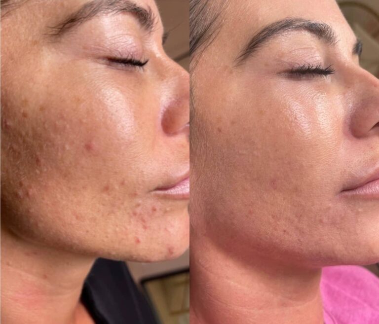 A before and after image of a stunning transformation through the Obagi Medical Grade Skincare treatment through BU Aesthetics