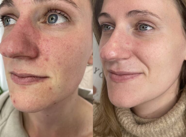 A before and after image of a woman's amazing transformation after undergoing the Obagi Medical Grade Skincare treatment