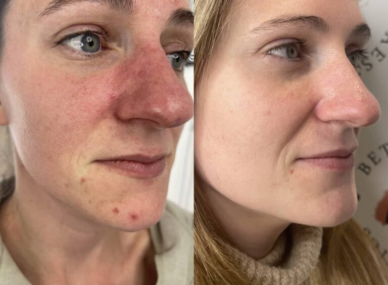 A before and after image of a woman undergoing the Obagi Medical Grade Skincare treatment with BU Aesthetics
