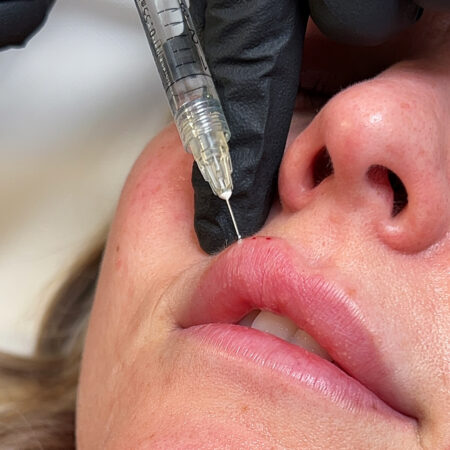 Lip-Filler-Side-Effects -Liverpool