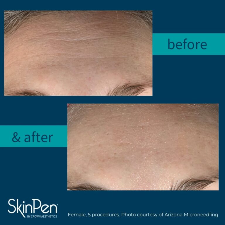 A before and after comparison of a Skinpen Precision procedure